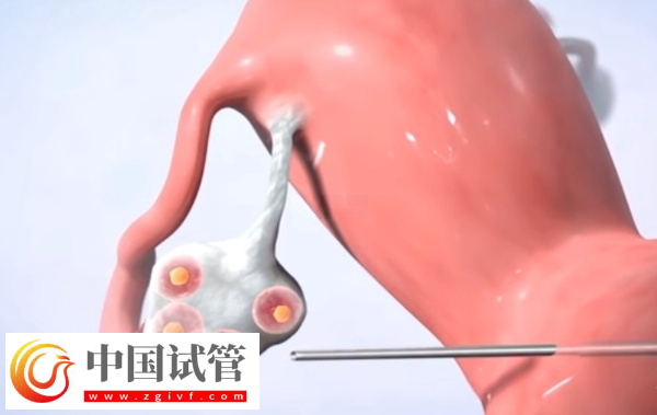 广州冻卵是否合法(图2) 广州冻卵是否合法(图2)