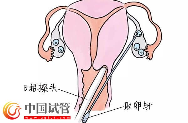 试管婴儿中用果纳芬好不好(图3) 试管婴儿中用果纳芬好不好(图3)